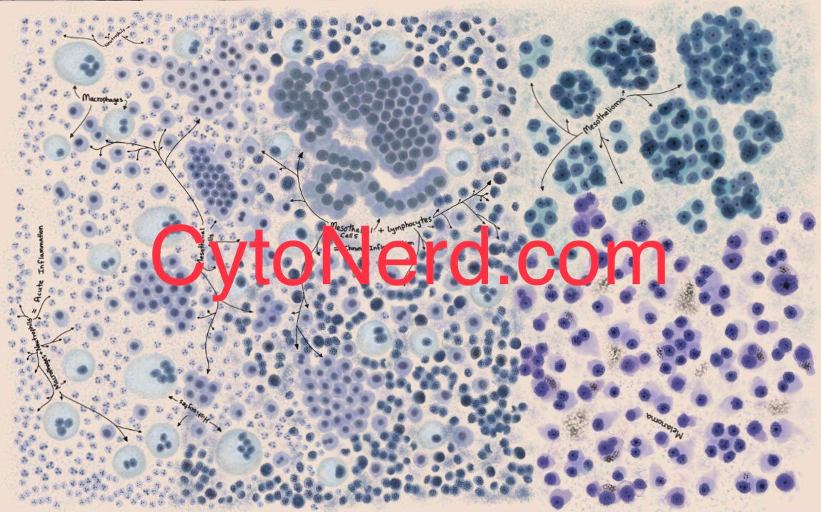 Mesothelial cells, body fluid Poster, Adenocarcinoma Cells art print, cancer colorful Cytology cells, carcinoma