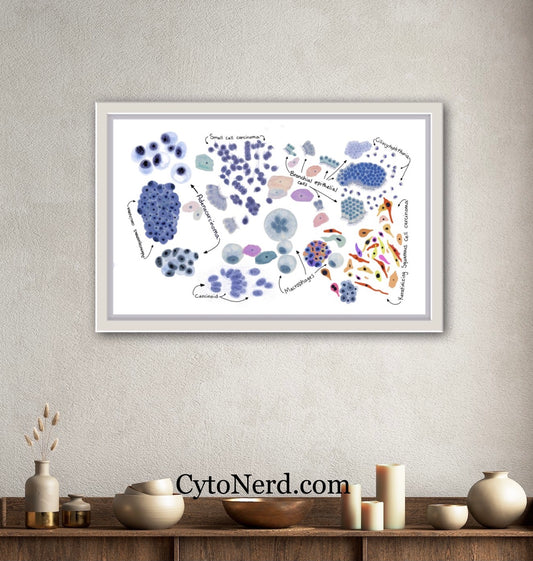 Lung cancer Poster, Adenocarcinoma Cells art print, cancer colorful Cytology cells poster small cell carcinoma