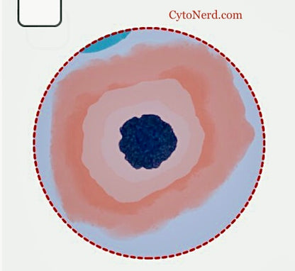 Stickers of colorful skin cell- Low-grade dysplasia squamous cell stickers.  Shows HPV affect or koilocytic changes.
