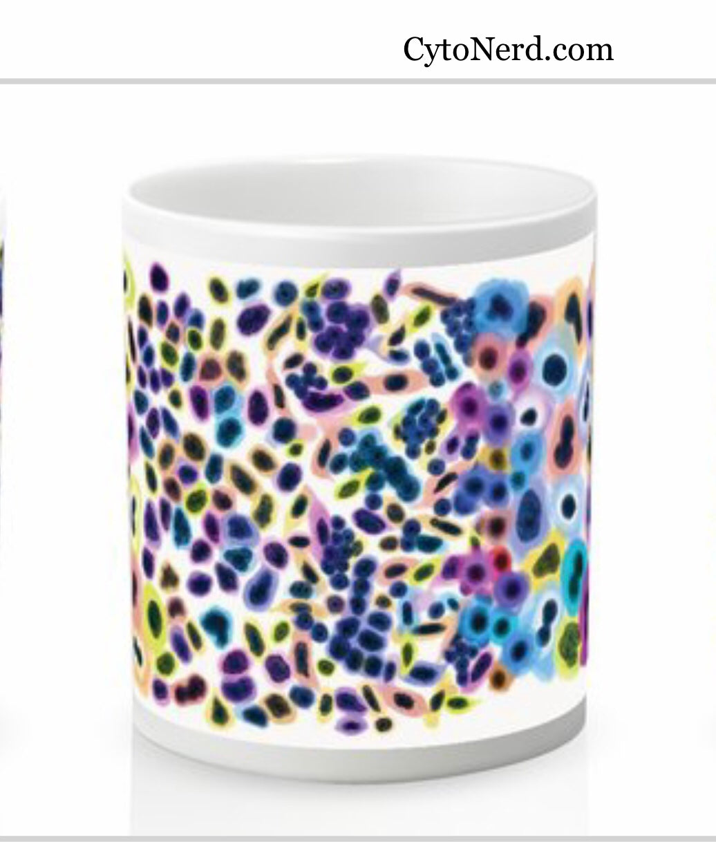 Mugs with abnormal cells from the cervix, coffee cup, ceramic cup with cells -  Dysplasia