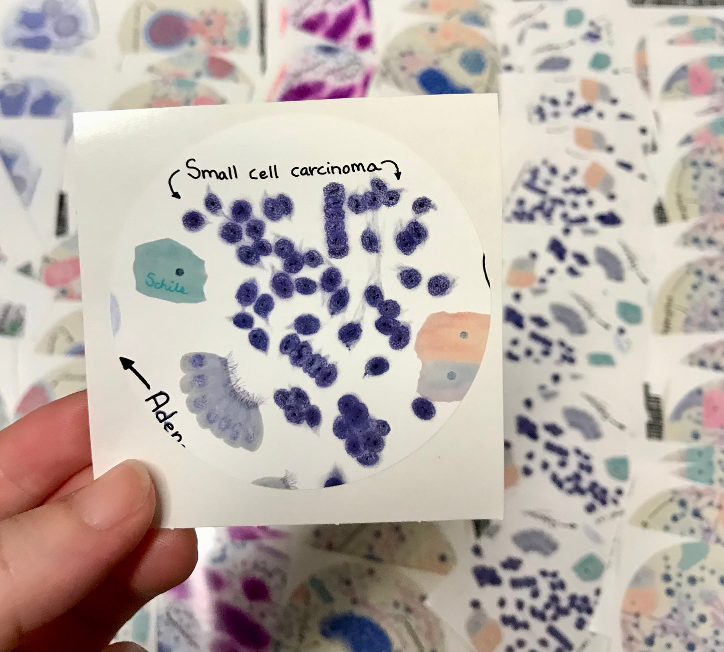 Small Cell Carcinoma - lung Cancer Stickers