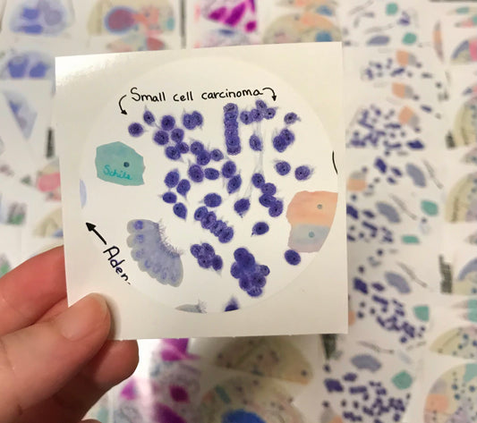 Small Cell Carcinoma - lung Cancer Stickers