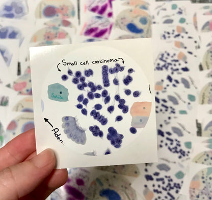 Small Cell Carcinoma - lung Cancer Stickers