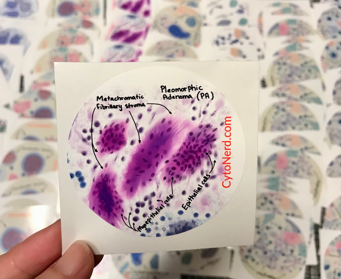 PA Pleomorphic Adenoma Stickers