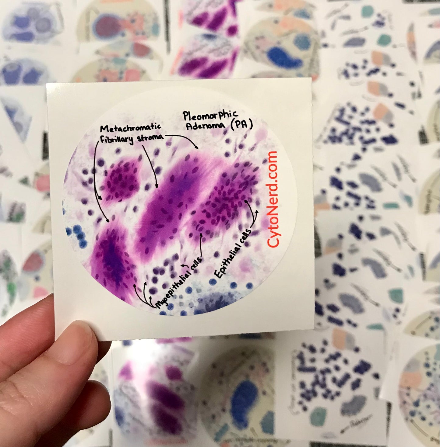 PA Pleomorphic Adenoma Stickers