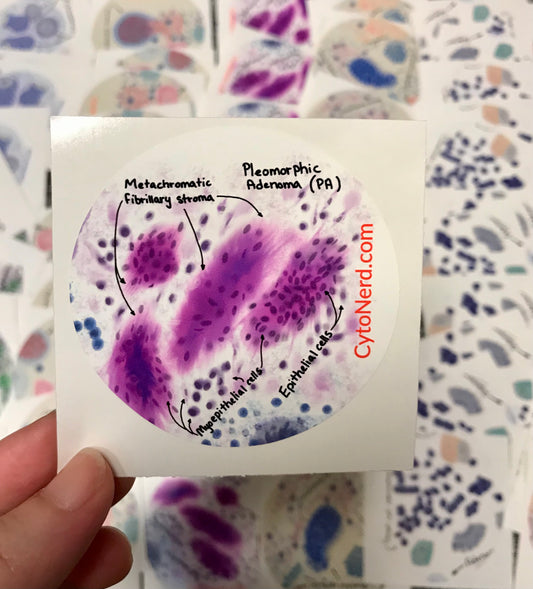 PA Pleomorphic Adenoma Stickers