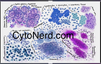 Salivary gland Poster, Pleomorphic adenoma, Cytology cells artwork, pathology laboratory art print