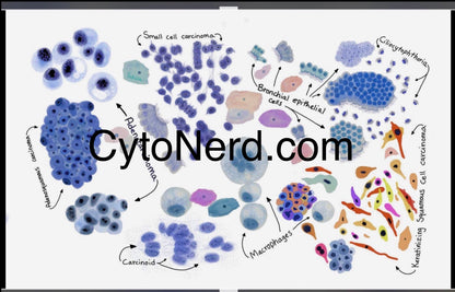 Lung cancer Poster, Adenocarcinoma Cells art print, cancer colorful Cytology cells poster small cell carcinoma