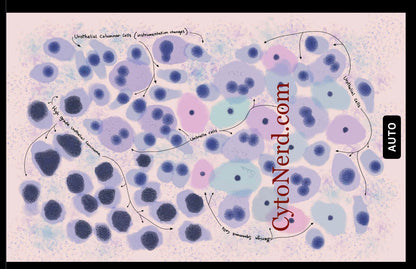 HGSIL - Urine Cells Poster, Urothelial cells, Bladder cancer art print, cancer colorful Cytology cells artwork