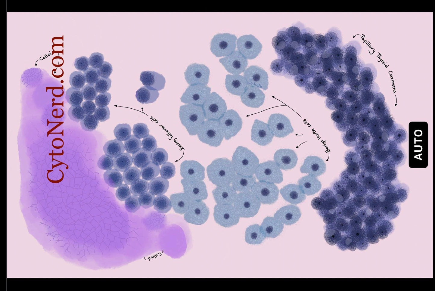 Colloid Cytology cells, Thyroid poster study guide