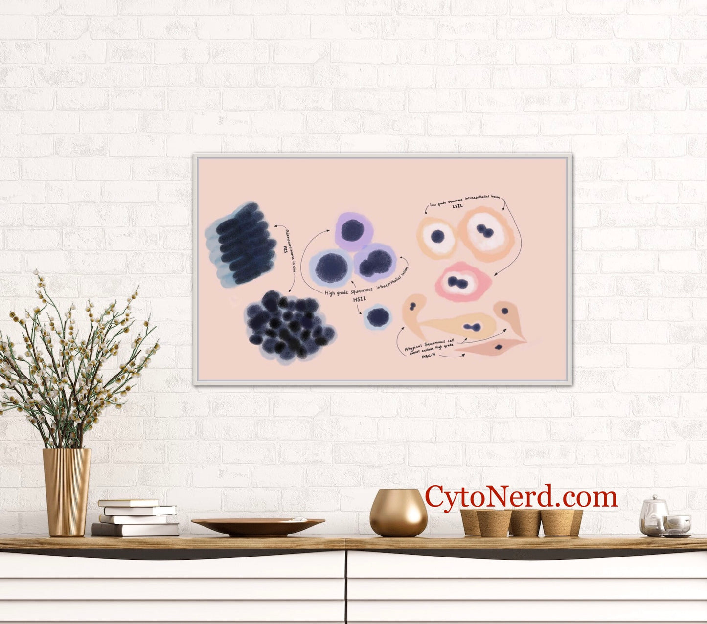 LSIL - Squamous cells dysplasia Poster, Cytology cells, cervical Art Print, Candida, Trich, Herpes