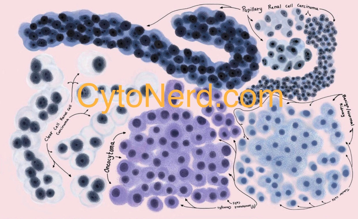 Renal cells, clear cell Poster, Adenocarcinoma Cells art print, cancer colorful Cytology cells, carcinoma