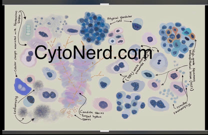 Squamous cells dysplasia Poster, Cytology cells, cervical Art Print, Candida, Trich, Herpes