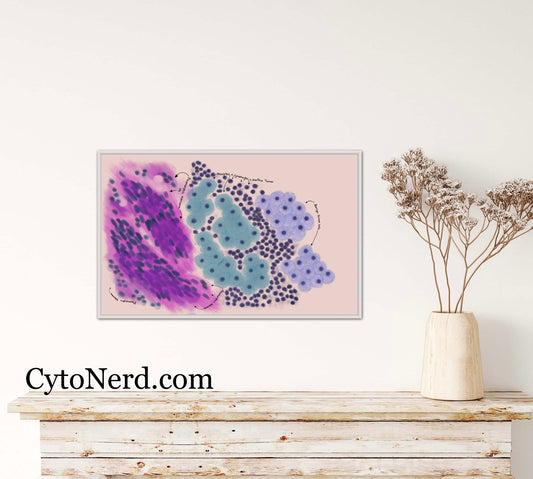 PA - Salivary gland Poster, Pleomorphic adenoma, Cytology cells art