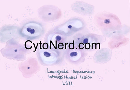 LSIL Squamous cells poster, Cells art print, cancer colorful Cytology cells Pathology artwork posters prints