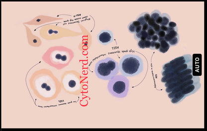 LSIL - Squamous cells dysplasia Poster, Cytology cells, cervical Art Print, Candida, Trich, Herpes