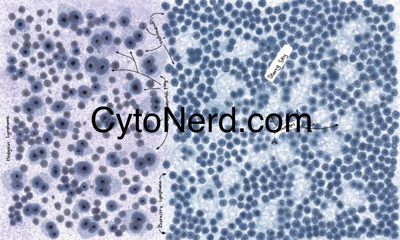 White blood cells, lymphoma poster, cells, clear cell Poster, Adenocarcinoma Cells art print, cancer colorful Cytology cells