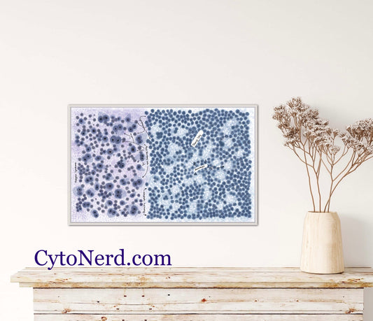 White blood cells, lymphoma poster, cells, clear cell Poster, Adenocarcinoma Cells art print, cancer colorful Cytology cells