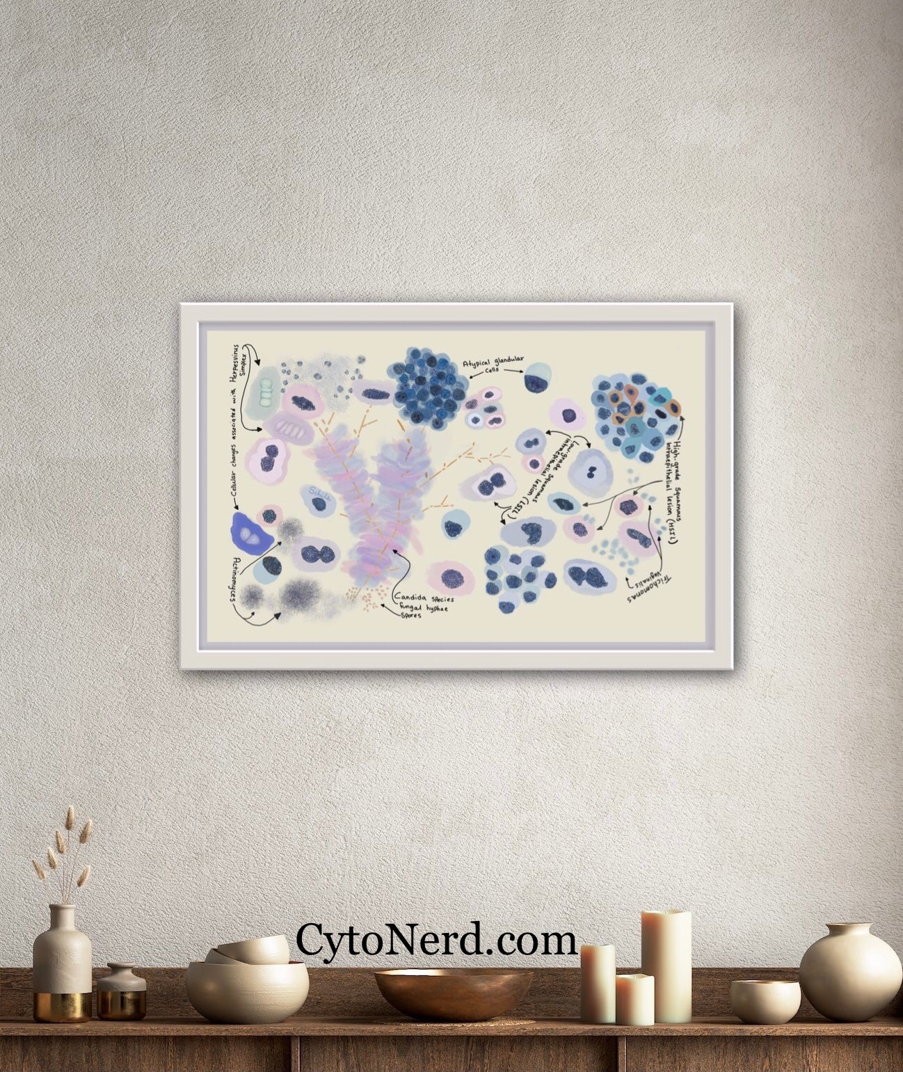 Squamous cells dysplasia Poster, Cytology cells, cervical Art Print, Candida, Trich, Herpes