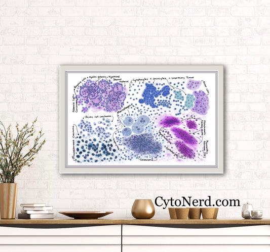 Salivary gland Poster, Pleomorphic adenoma, Cytology cells artwork, pathology laboratory art print