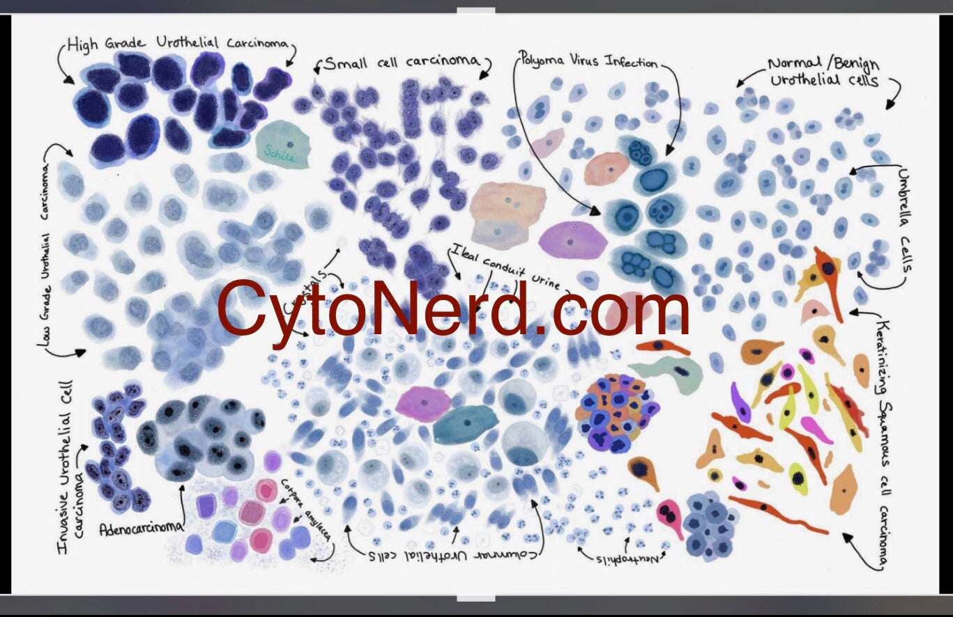 Urine Cells Poster, Urothelial cells, Bladder cancer art print, cancer colorful Cytology cells artwork