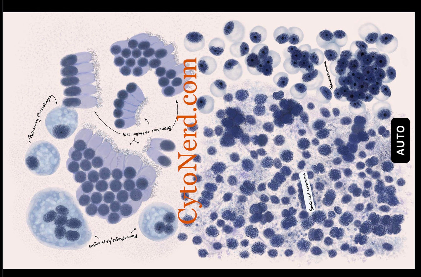 Lung study guide, Adenocarcinoma Cells art, Cytology cells poster small cell carcinoma