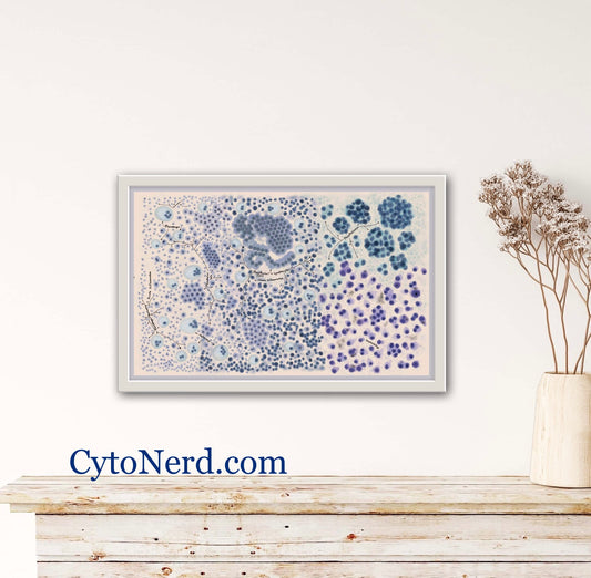 Mesothelial cells, body fluid Poster, Adenocarcinoma Cells art print, cancer colorful Cytology cells, carcinoma