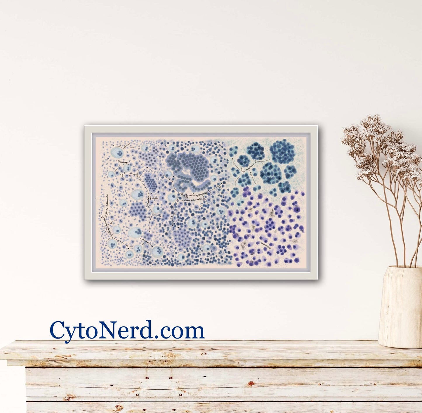 Mesothelial cells, body fluid Poster, Adenocarcinoma Cells art print, cancer colorful Cytology cells, carcinoma