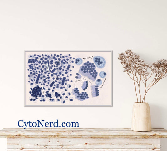 Lung study guide, Adenocarcinoma Cells art, Cytology cells poster small cell carcinoma