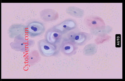 LSIL Squamous cells poster, Cells art print, cancer colorful Cytology cells Pathology artwork posters prints