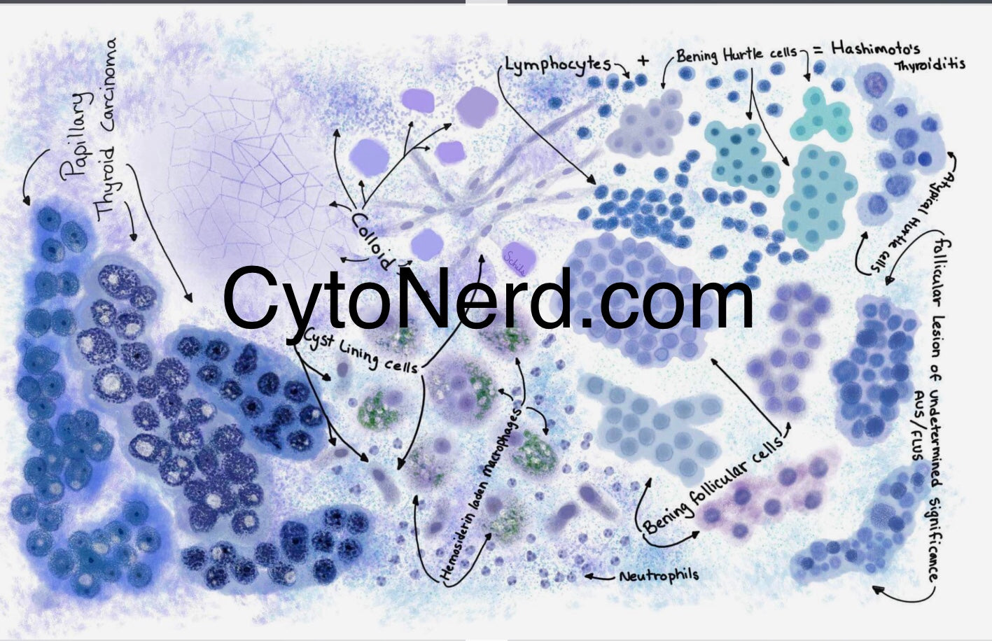 Thyroid art print Poster, Colloid Cytology cells, FLUS, follicular lesion, Hurtle cells