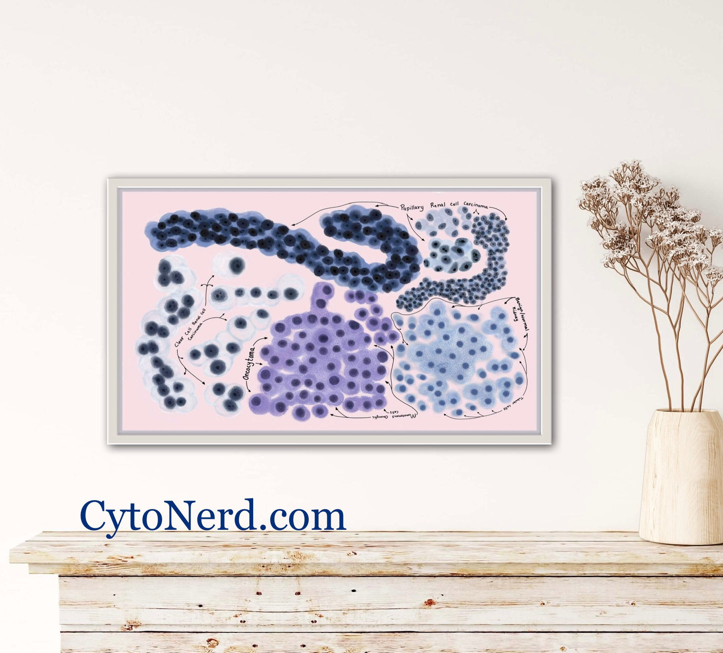 Renal cells, clear cell Poster, Adenocarcinoma Cells art print, cancer colorful Cytology cells, carcinoma